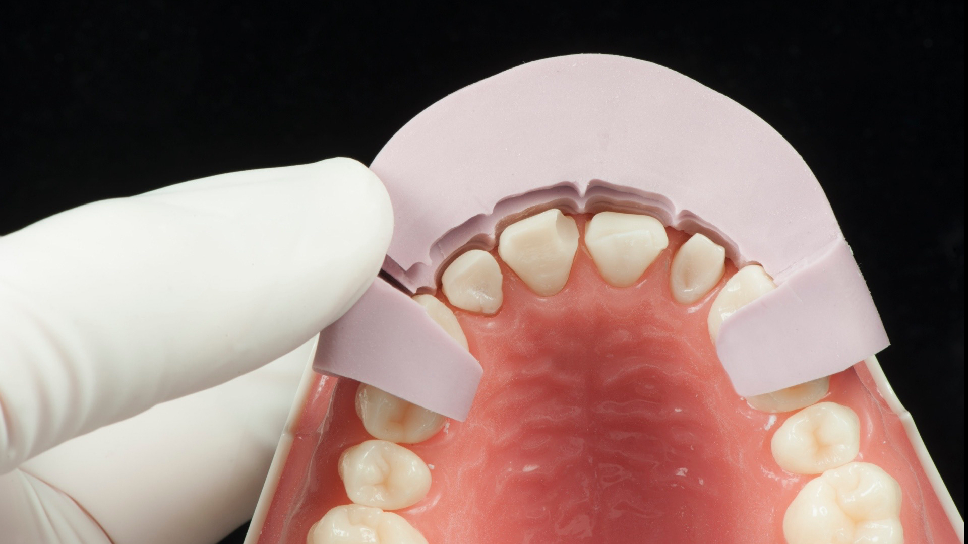 Estetik Braket Tekniği